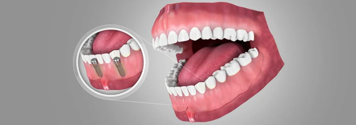 Implant Supported Denture
