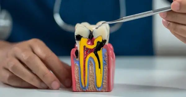 5 Aftercare Tips for Root Canal Treatment in Palm Desert