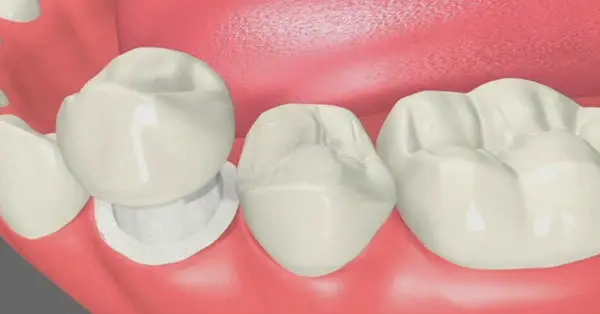 A Complete Guide to Types of Dental Crowns in Palm Desert