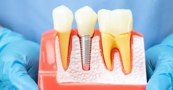Illustration showing a missing tooth replacement using dental implants in Palm Desert