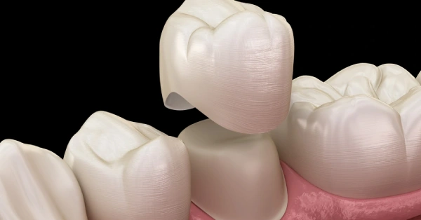 Do I Need a Crown After Root Canal Treatment in Palm Desert?