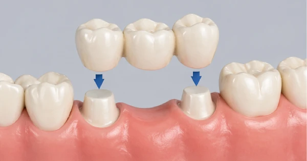 Dental bridge replacing a missing tooth, showing how dental bridges in La Quinta help prevent tooth shifting