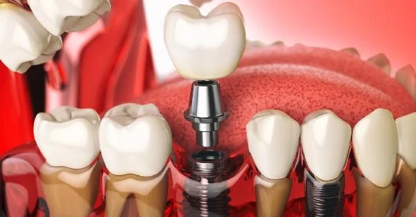 Pain-Free Dental Implants in Palm Desert for Everyday Smiles