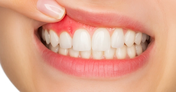 Top 5 Signs You May Need Periodontal Care in Palm Springs