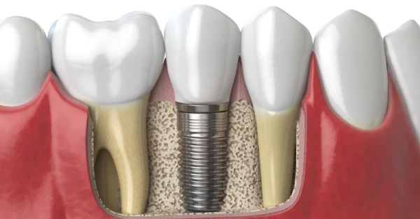 Dental implant placed in jawbone between natural teeth showing structure and surrounding gum health