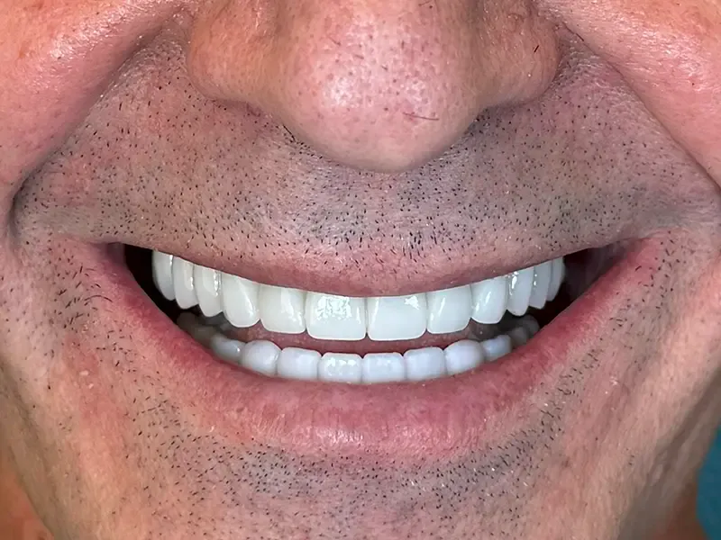 Happy patient with a beautiful, restored smile