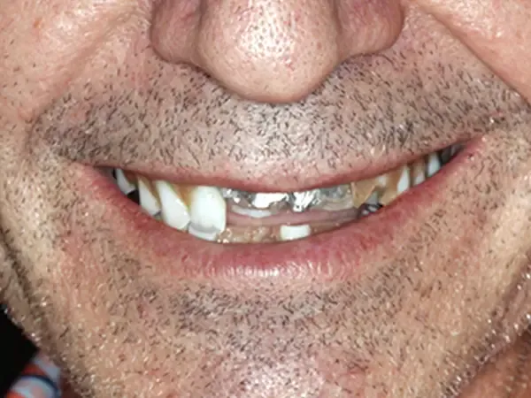 Patient's smile before — failing dental work visible