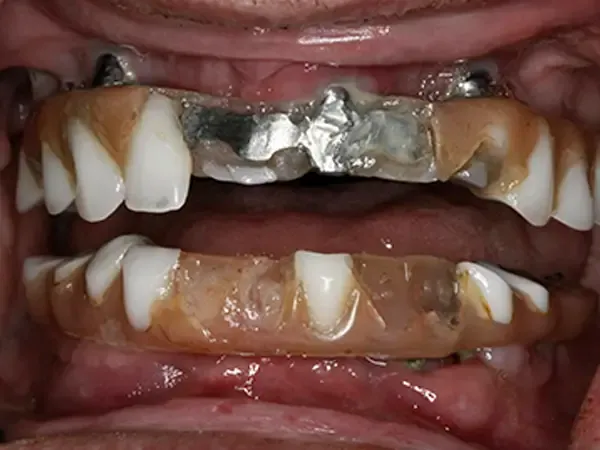 Close-up of failing dental implants and prosthesis