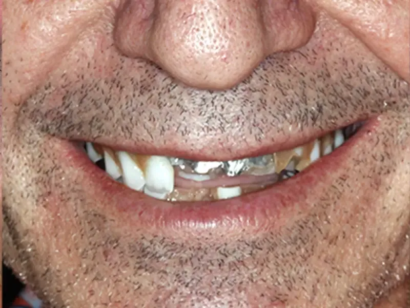 Patient smile before restoration