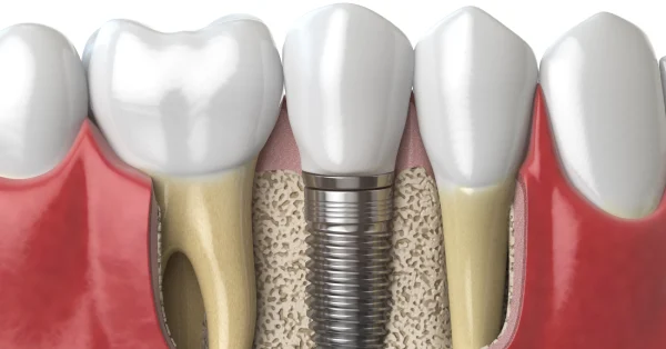 5 Key Signs You Need Dental Implants in Palm Desert