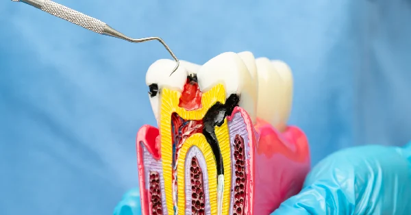 5 Signs You Need a Root Canal Treatment in Rancho Mirage