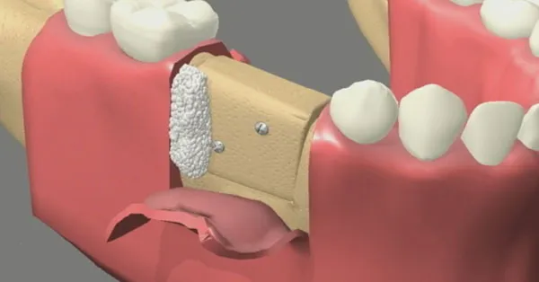 Bone Graft: Purpose, Procedure, and Risks | Rancho Mirage