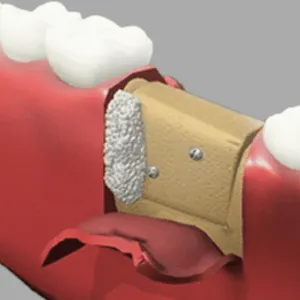 Bone grafting Rancho Mirage, Palm Desert, Palm Spring, Coachella Valley, Cathedral City, La Quinta, Desert Hot Springs, Yucca Valley, Indian Wells