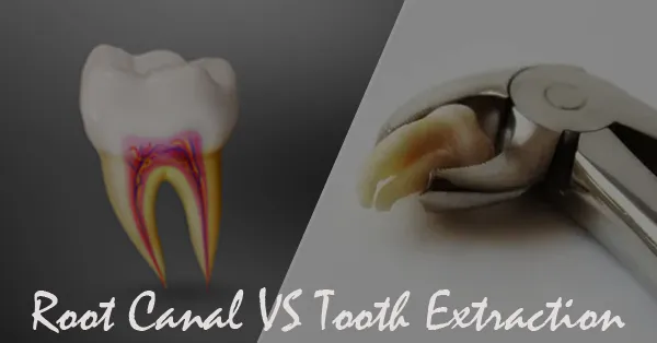 Difference Between Root Canal and Tooth Extraction