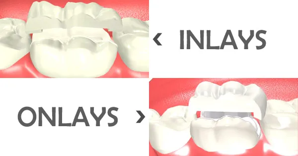 Dental Inlay & Onlay : What's The Difference