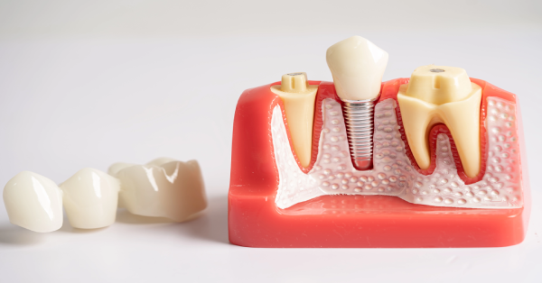 Preventing Bone Loss with Dental Implants: A Lifelong Solution