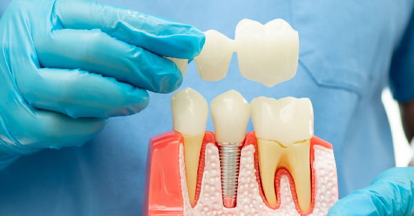 Revive Your Smile with Dental Crowns and Bridges in Palm Desert