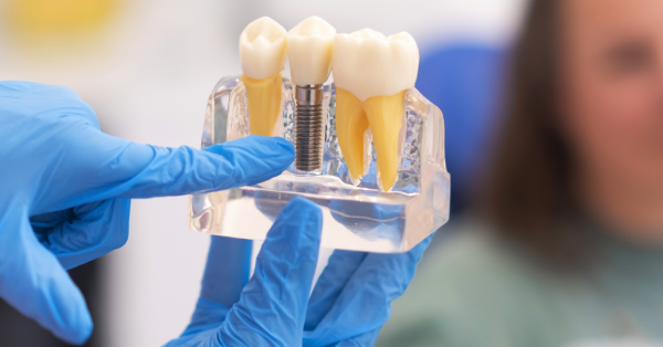 Step-by-Step Procedure for Dental Implants in La Quinta